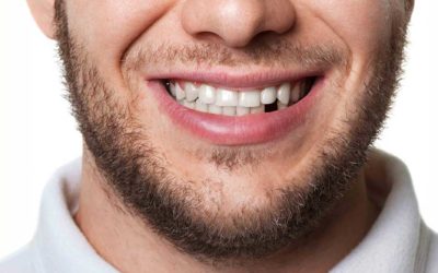 Emergency Dentist in Orange NSW: What to Do When a Tooth Breaks at 9 PM