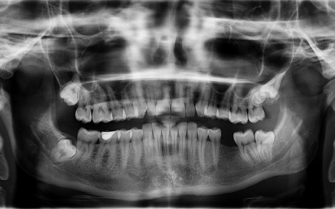 Wisdom Teeth: What Are They, and Why Do We Have Them?